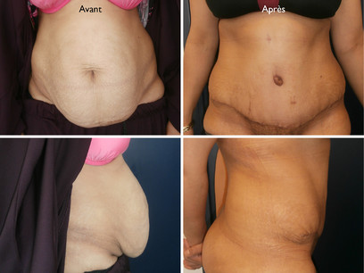 abdominoplastie 1